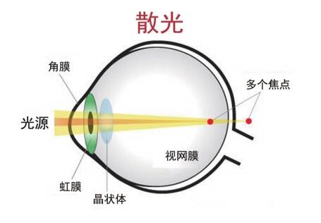 散光的主要癥狀有哪些？