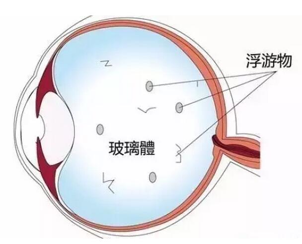 眼前突然出現(xiàn)黑影飄，到底要怎么辦才好？