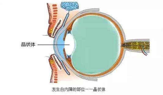 白內(nèi)障，不會不會致盲？